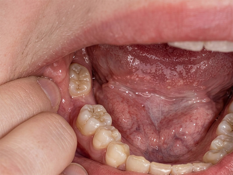 第二大臼齒缺牙